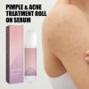 Eelhoe Acne Acne Ball, And Cleansing Skin Chest Back Acne Closing Skin Care