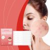 Jaysuing Acne Patch Semi-Transparent Acne Cover Patch Comfortable, Gentle, Easy To Apply Makeup, Waterproof And Breathable
